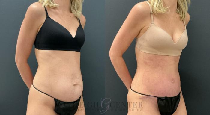 Tummy Tuck Case 778 Before & After Right Oblique | The Woodlands, TX | The Gill Center for Plastic Surgery and Dermatology