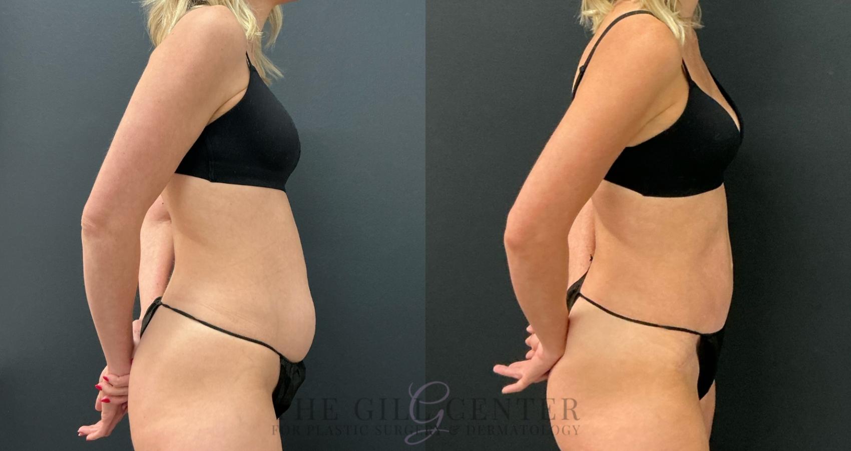 Tummy Tuck Case 778 Before & After Right Side | The Woodlands, TX | The Gill Center for Plastic Surgery and Dermatology