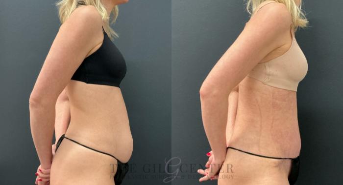 Tummy Tuck Case 778 Before & After Right Side | The Woodlands, TX | The Gill Center for Plastic Surgery and Dermatology