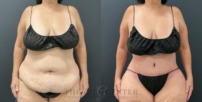 Tummy Tuck Case 779 Before & After Front | The Woodlands, TX | The Gill Center for Plastic Surgery and Dermatology