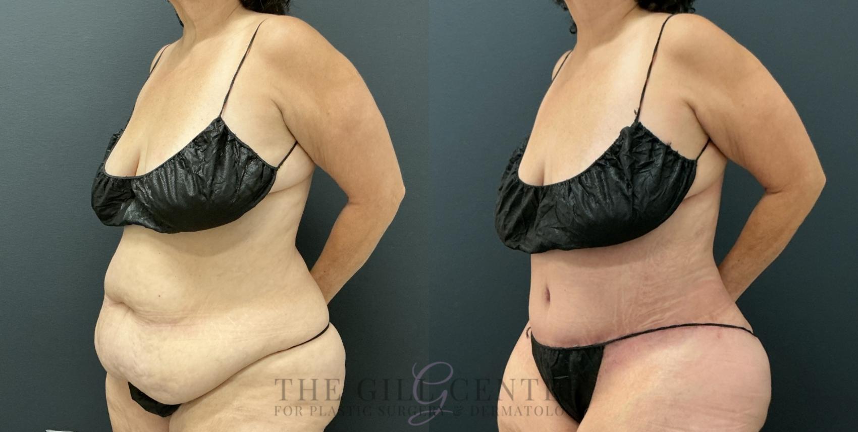 Tummy Tuck Case 779 Before & After Left Oblique | The Woodlands, TX | The Gill Center for Plastic Surgery and Dermatology
