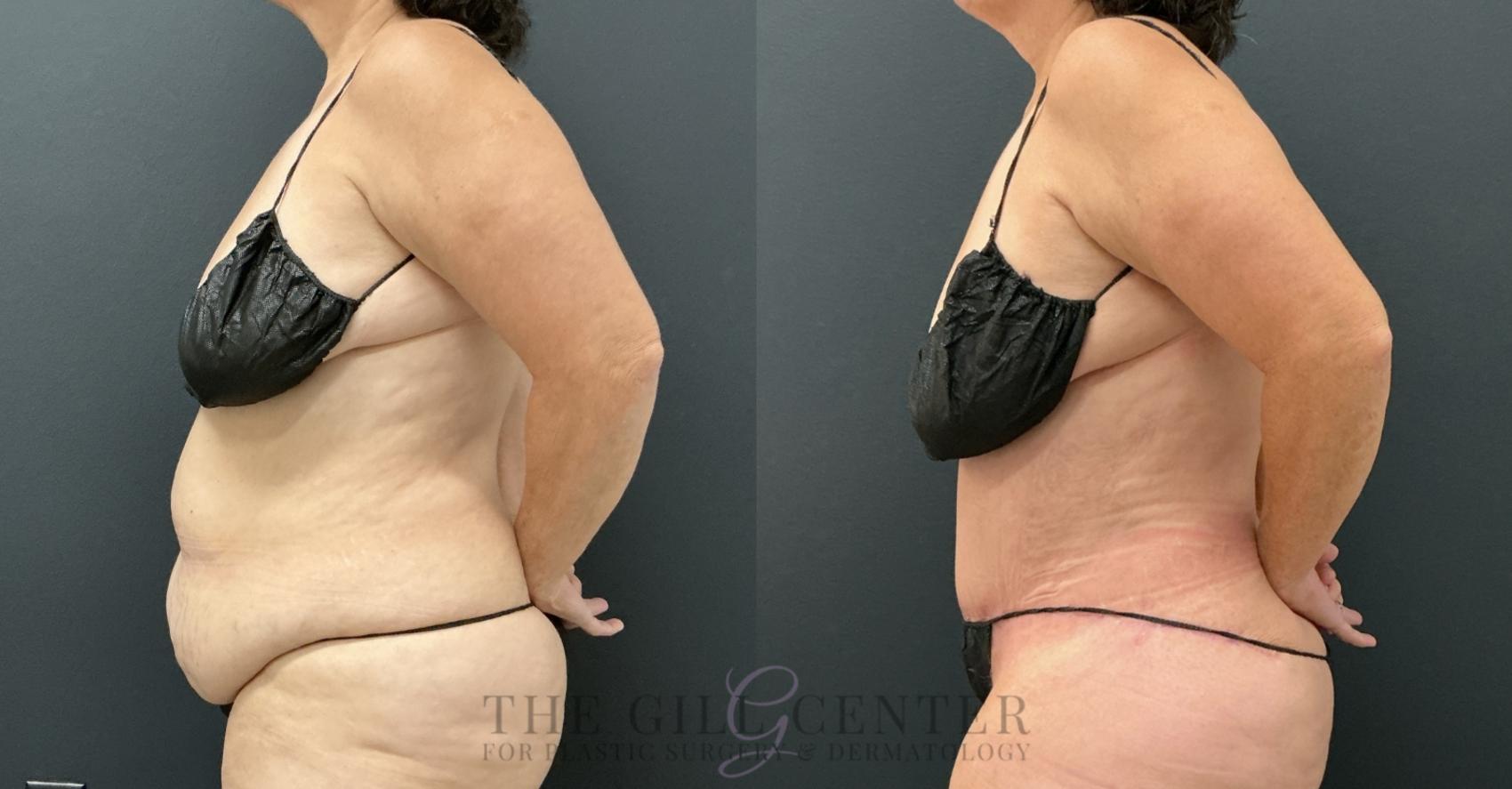 Tummy Tuck Case 779 Before & After Left Side | The Woodlands, TX | The Gill Center for Plastic Surgery and Dermatology