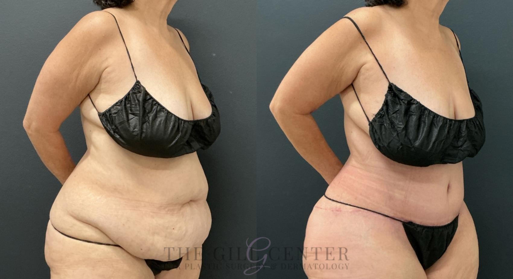 Tummy Tuck Case 779 Before & After Right Oblique | The Woodlands, TX | The Gill Center for Plastic Surgery and Dermatology