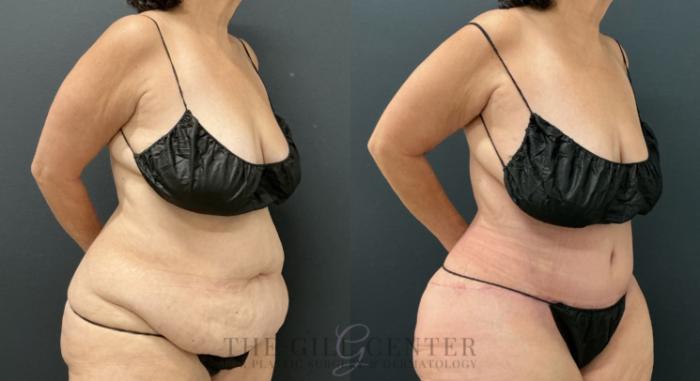 Tummy Tuck Case 779 Before & After Right Oblique | The Woodlands, TX | The Gill Center for Plastic Surgery and Dermatology
