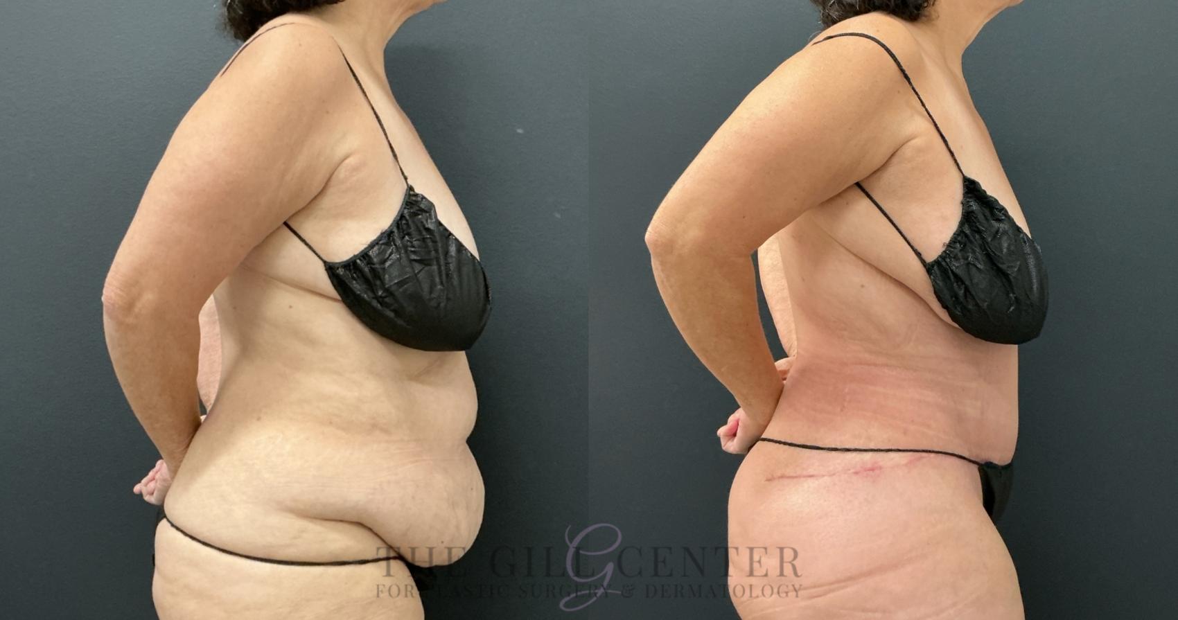 Tummy Tuck Case 779 Before & After Right Side | The Woodlands, TX | The Gill Center for Plastic Surgery and Dermatology