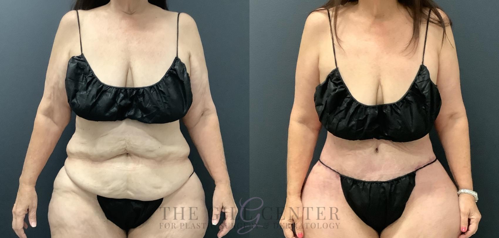 Tummy Tuck Case 797 Before & After Front | The Woodlands, TX | The Gill Center for Plastic Surgery and Dermatology