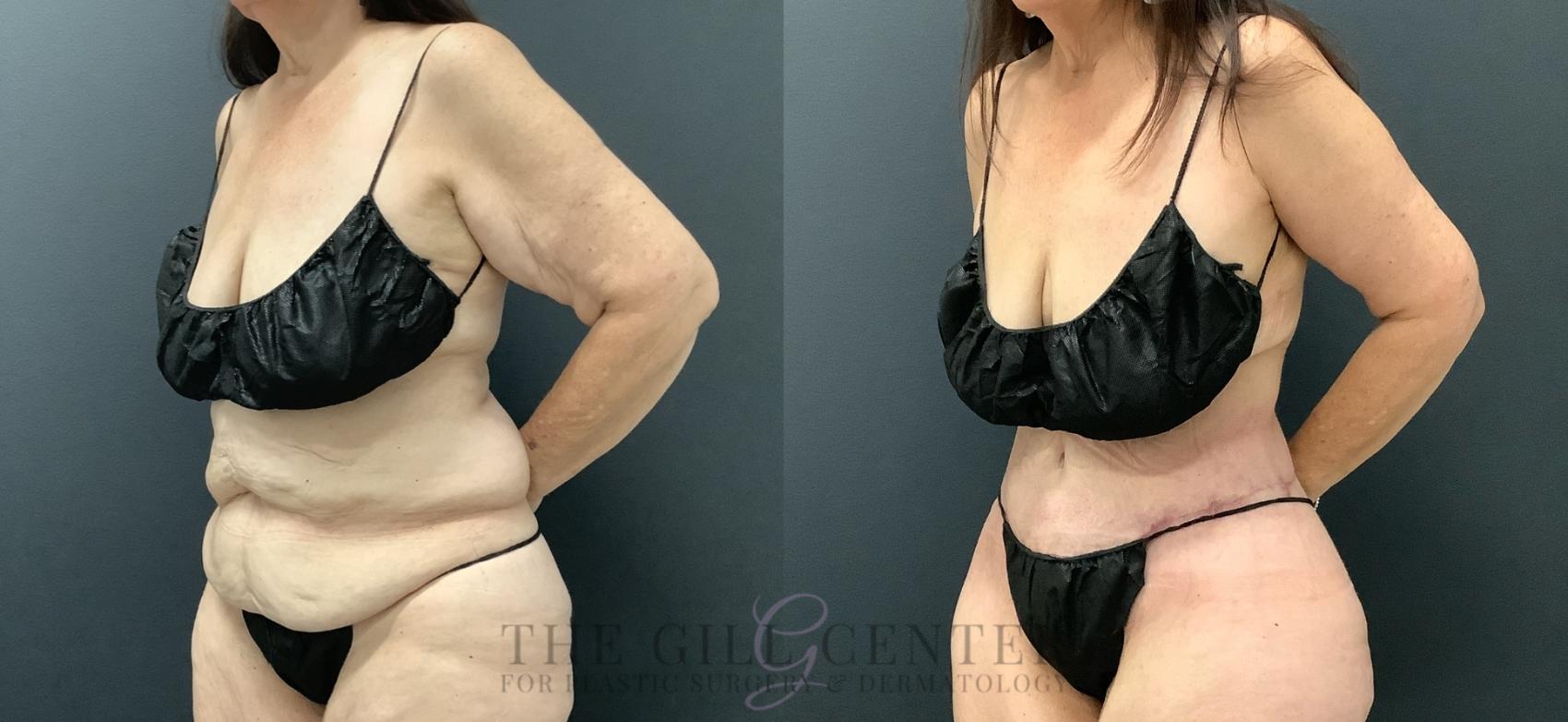 Tummy Tuck Case 797 Before & After Left Oblique | The Woodlands, TX | The Gill Center for Plastic Surgery and Dermatology