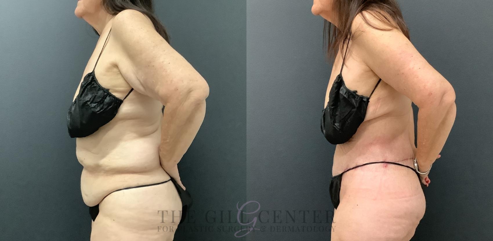 Tummy Tuck Case 797 Before & After Left Side | The Woodlands, TX | The Gill Center for Plastic Surgery and Dermatology