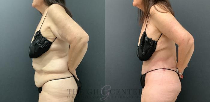 Tummy Tuck Case 797 Before & After Left Side | The Woodlands, TX | The Gill Center for Plastic Surgery and Dermatology