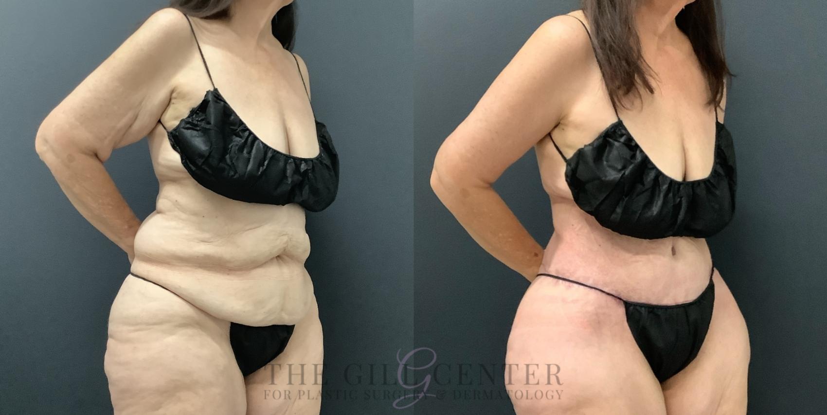 Tummy Tuck Case 797 Before & After Right Oblique | The Woodlands, TX | The Gill Center for Plastic Surgery and Dermatology