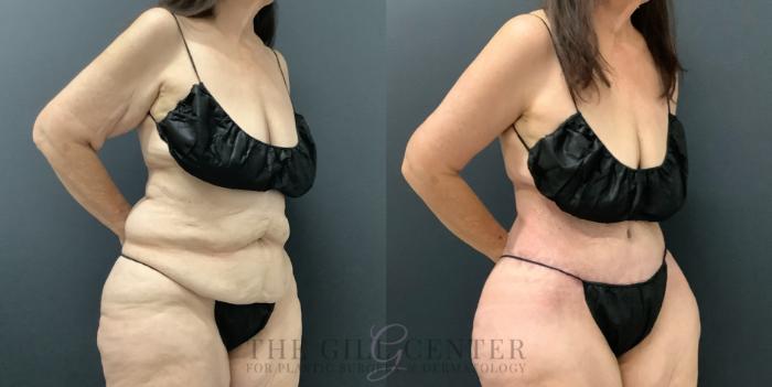 Tummy Tuck Case 797 Before & After Right Oblique | The Woodlands, TX | The Gill Center for Plastic Surgery and Dermatology