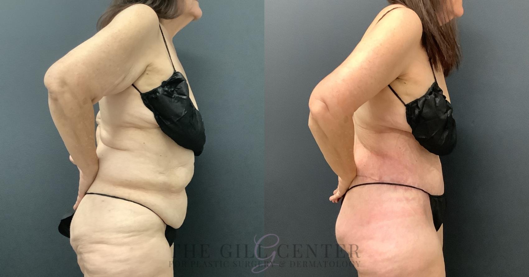Tummy Tuck Case 797 Before & After Right Side | The Woodlands, TX | The Gill Center for Plastic Surgery and Dermatology