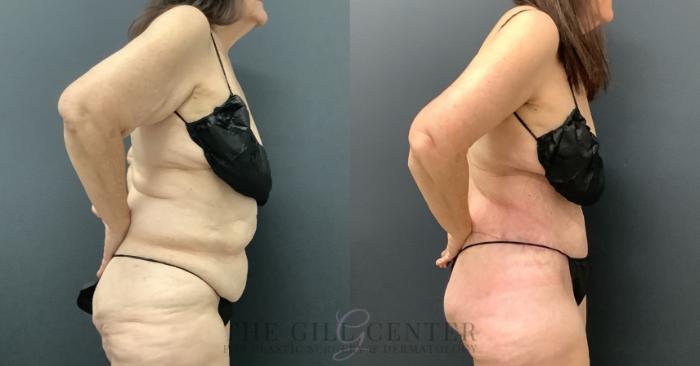 Tummy Tuck Case 797 Before & After Right Side | The Woodlands, TX | The Gill Center for Plastic Surgery and Dermatology