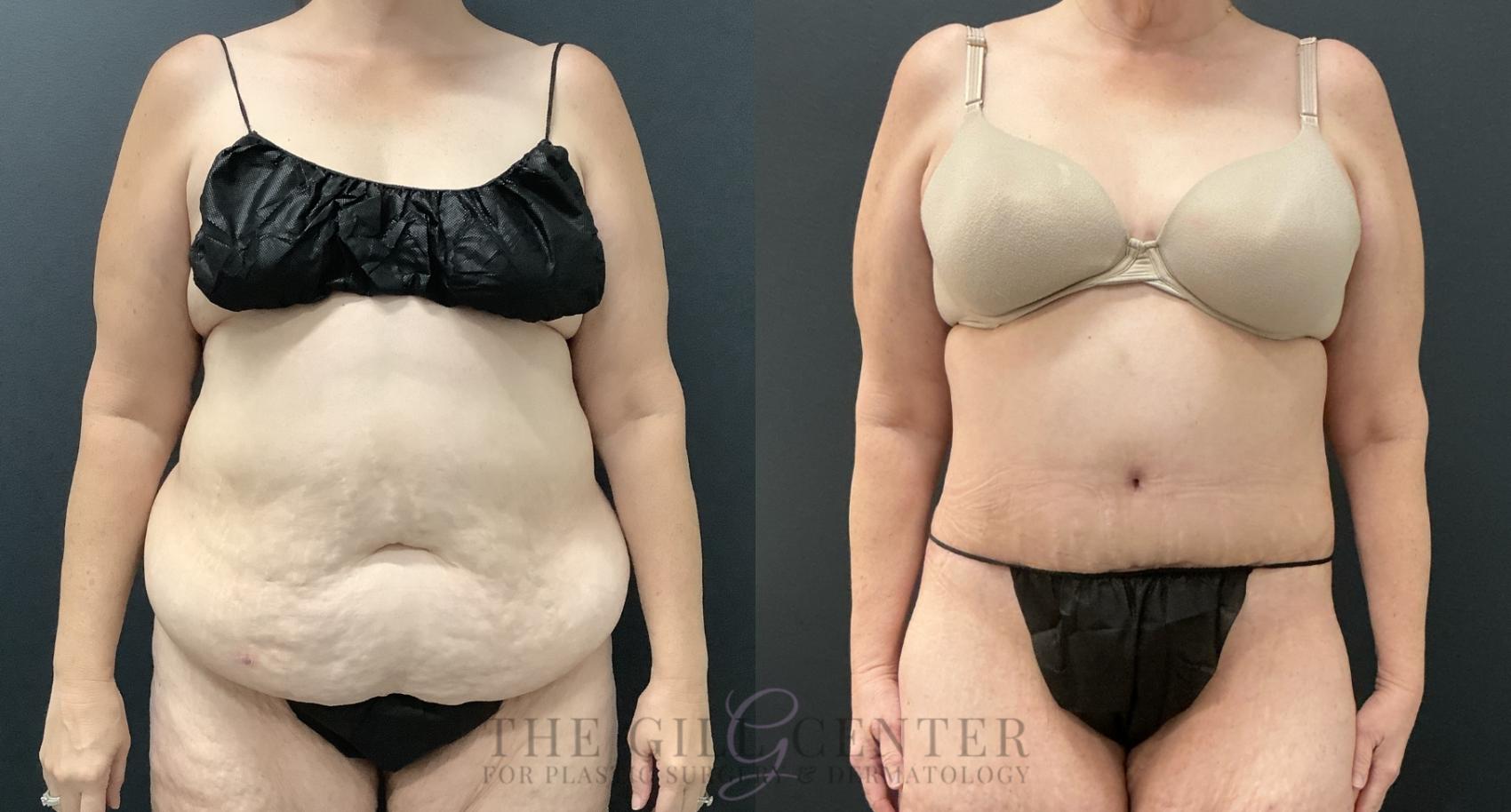 Tummy Tuck Case 803 Before & After Front | The Woodlands, TX | The Gill Center for Plastic Surgery and Dermatology