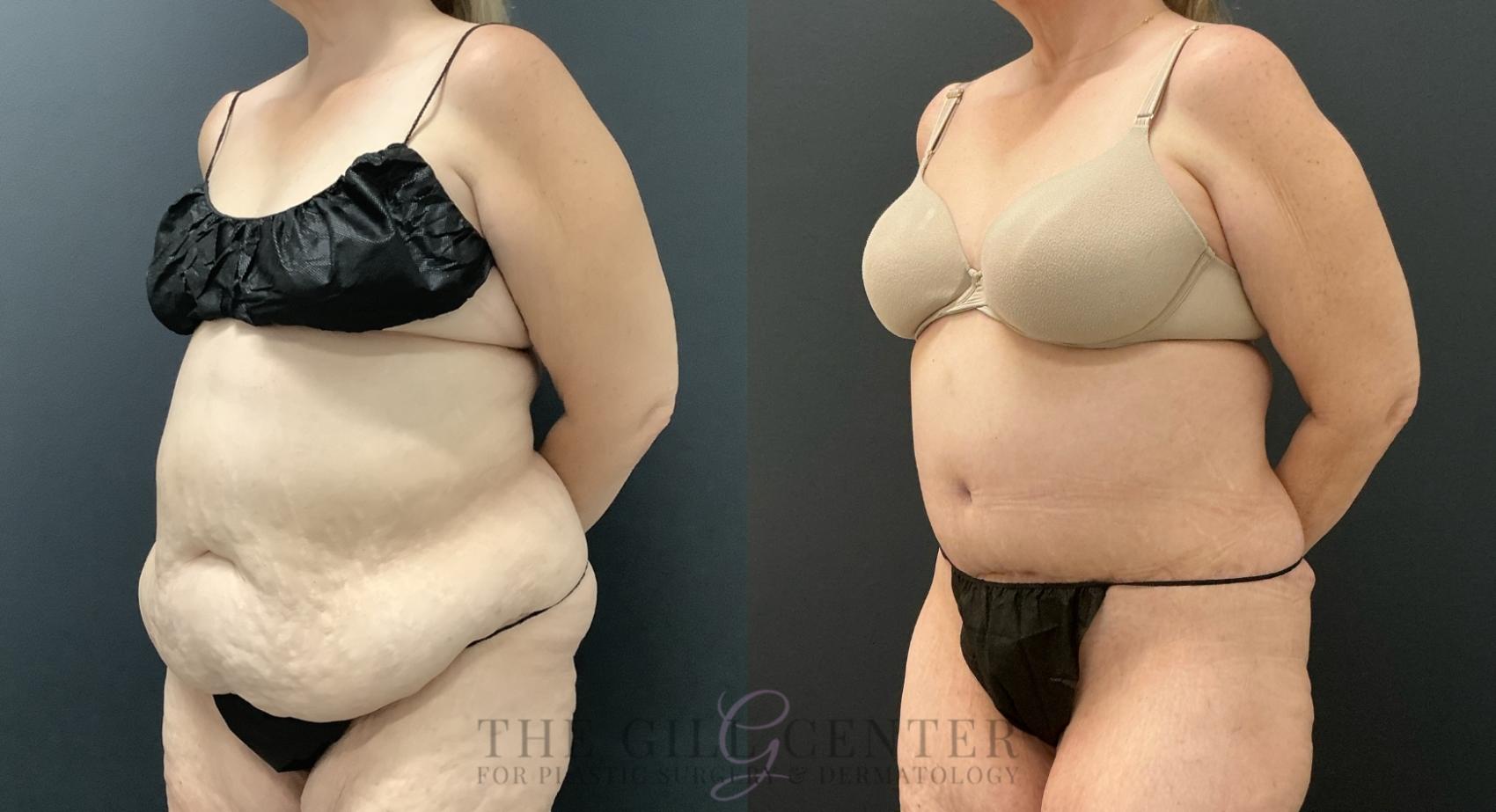 Tummy Tuck Case 803 Before & After Left Oblique | The Woodlands, TX | The Gill Center for Plastic Surgery and Dermatology