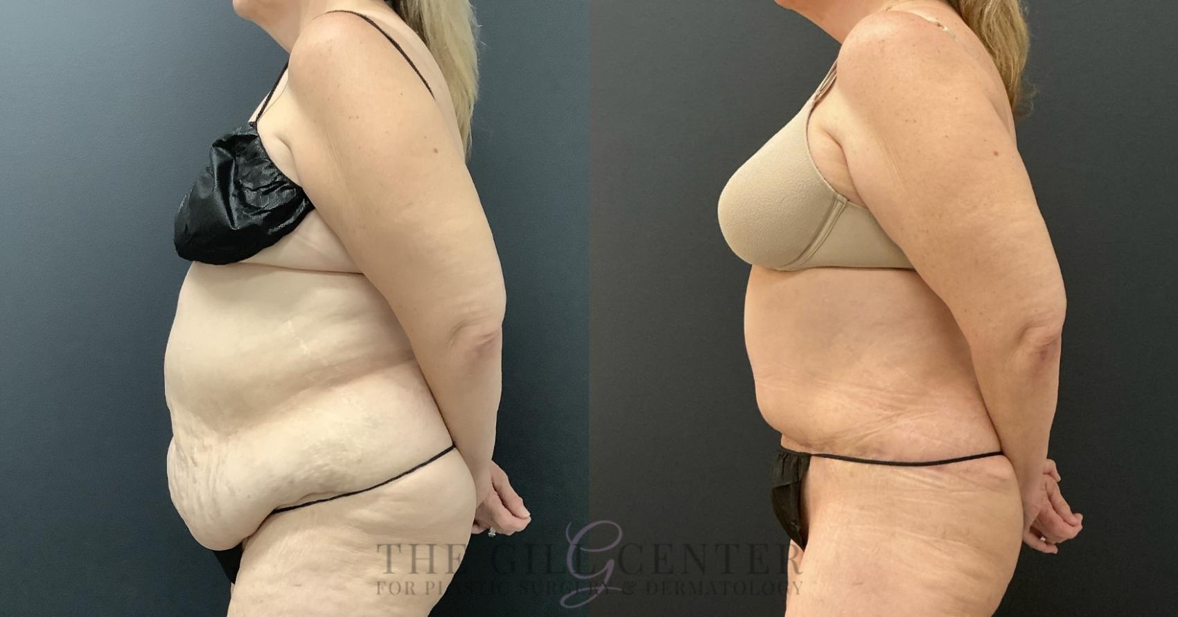 Tummy Tuck Case 803 Before & After Left Side | The Woodlands, TX | The Gill Center for Plastic Surgery and Dermatology