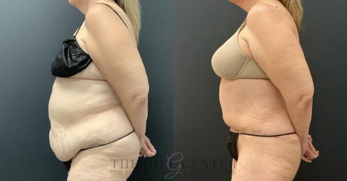 Tummy Tuck Case 803 Before & After Left Side | The Woodlands, TX | The Gill Center for Plastic Surgery and Dermatology