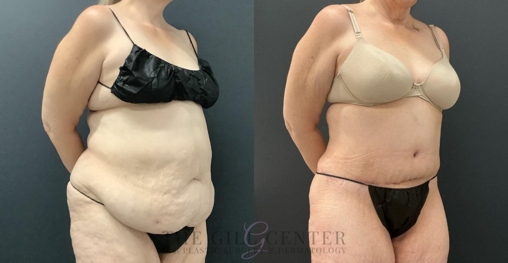Tummy Tuck Case 803 Before & After Right Oblique | The Woodlands, TX | The Gill Center for Plastic Surgery and Dermatology