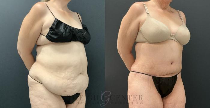 Tummy Tuck Case 803 Before & After Right Oblique | The Woodlands, TX | The Gill Center for Plastic Surgery and Dermatology