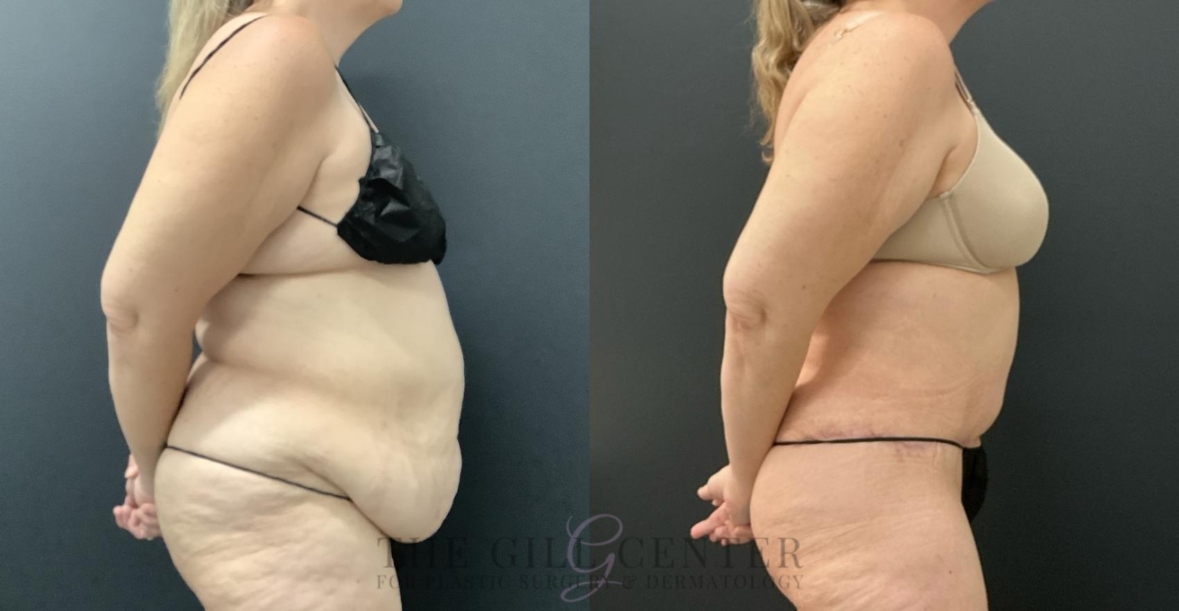 Tummy Tuck Case 803 Before & After Right Side | The Woodlands, TX | The Gill Center for Plastic Surgery and Dermatology