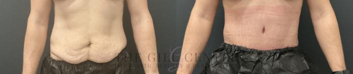 Tummy Tuck Case 805 Before & After Front | The Woodlands, TX | The Gill Center for Plastic Surgery and Dermatology