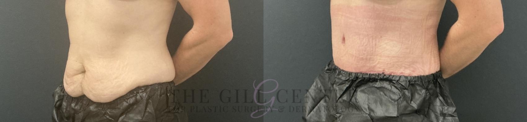 Tummy Tuck Case 805 Before & After Left Oblique | The Woodlands, TX | The Gill Center for Plastic Surgery and Dermatology