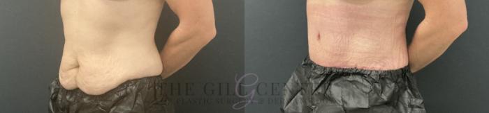 Tummy Tuck Case 805 Before & After Left Oblique | The Woodlands, TX | The Gill Center for Plastic Surgery and Dermatology