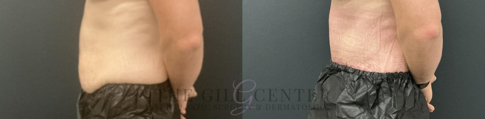 Tummy Tuck Case 805 Before & After Left Side | The Woodlands, TX | The Gill Center for Plastic Surgery and Dermatology