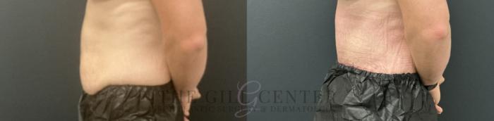 Tummy Tuck Case 805 Before & After Left Side | The Woodlands, TX | The Gill Center for Plastic Surgery and Dermatology