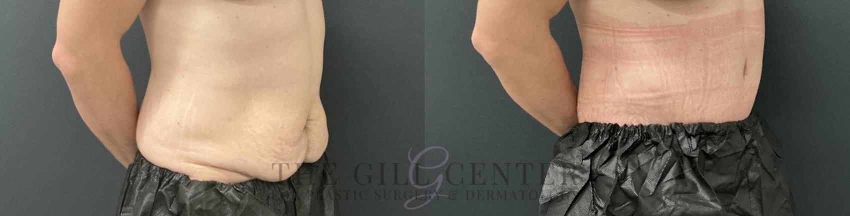Tummy Tuck Case 805 Before & After Right Oblique | The Woodlands, TX | The Gill Center for Plastic Surgery and Dermatology