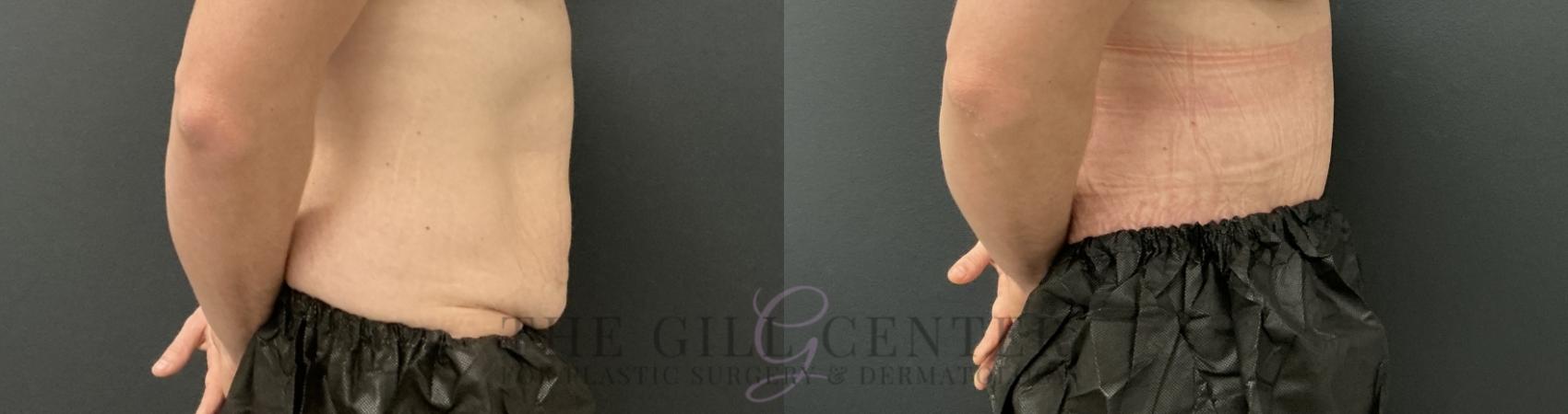 Tummy Tuck Case 805 Before & After Right Side | The Woodlands, TX | The Gill Center for Plastic Surgery and Dermatology