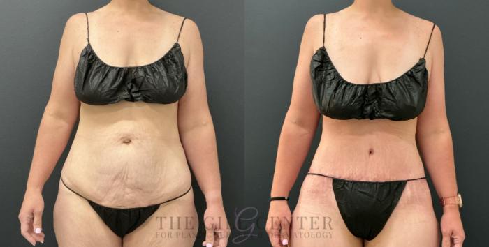 Tummy Tuck Case 809 Before & After Front | The Woodlands, TX | The Gill Center for Plastic Surgery and Dermatology