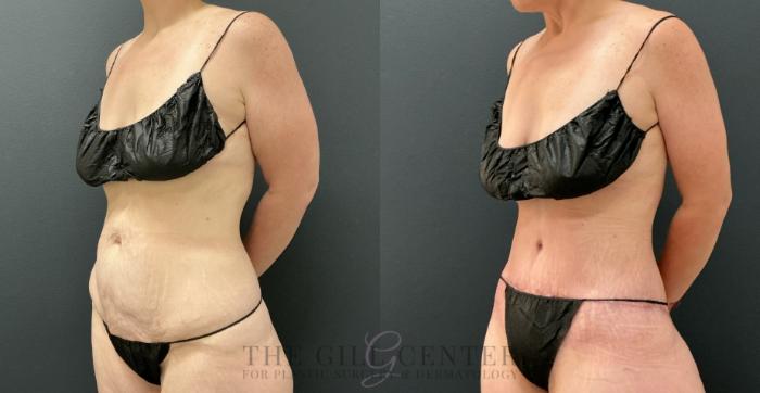 Tummy Tuck Case 809 Before & After Left Oblique | The Woodlands, TX | The Gill Center for Plastic Surgery and Dermatology
