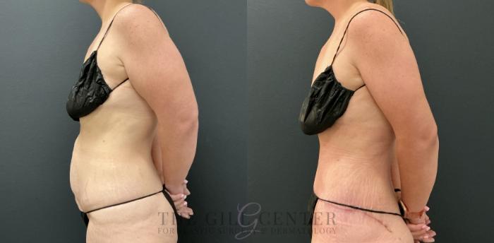 Tummy Tuck Case 809 Before & After Left Side | The Woodlands, TX | The Gill Center for Plastic Surgery and Dermatology