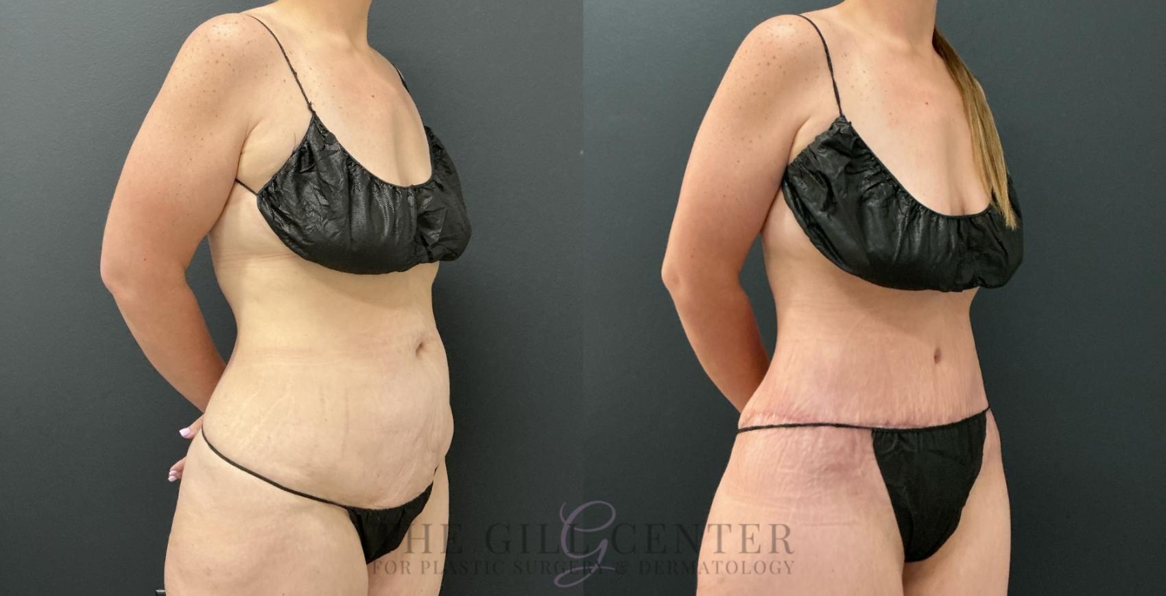 Tummy Tuck Case 809 Before & After Right Oblique | The Woodlands, TX | The Gill Center for Plastic Surgery and Dermatology