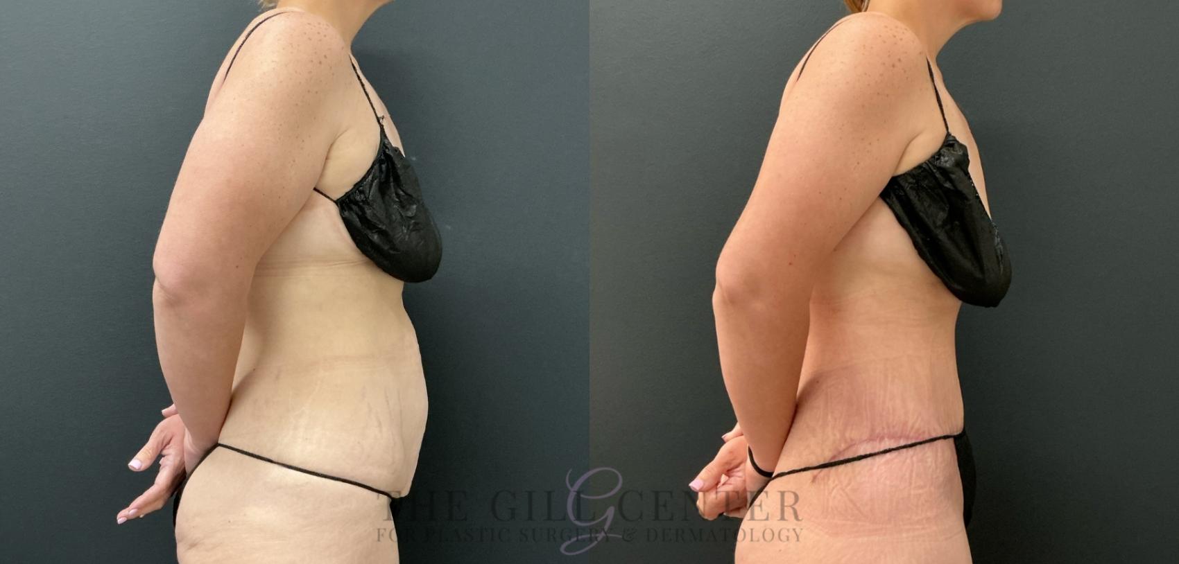 Tummy Tuck Case 809 Before & After Right Side | The Woodlands, TX | The Gill Center for Plastic Surgery and Dermatology