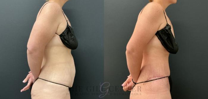 Tummy Tuck Case 809 Before & After Right Side | The Woodlands, TX | The Gill Center for Plastic Surgery and Dermatology