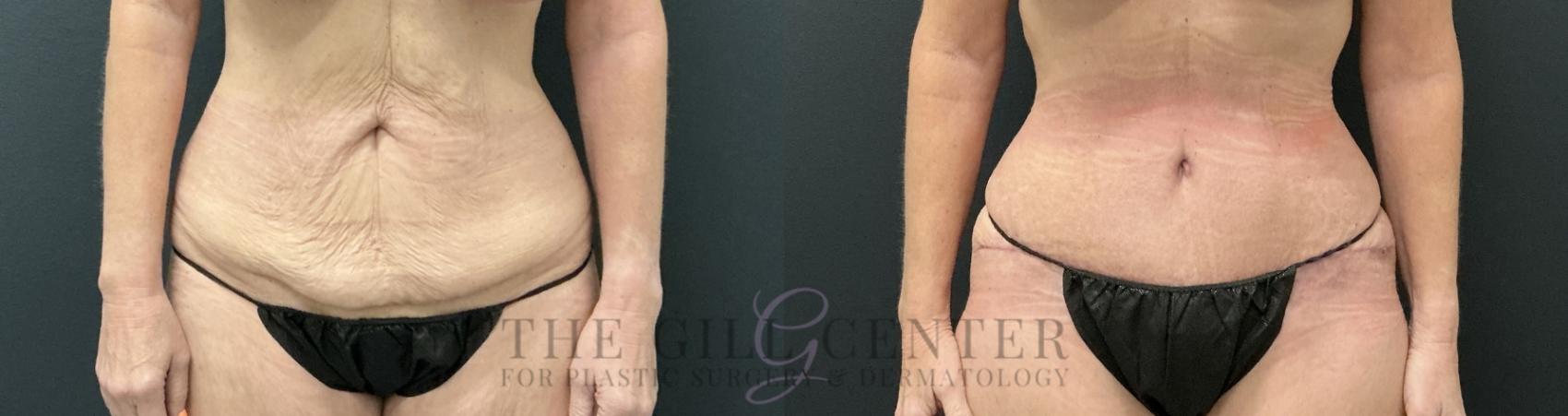 Tummy Tuck Case 813 Before & After Front | The Woodlands, TX | The Gill Center for Plastic Surgery and Dermatology