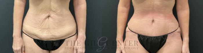 Tummy Tuck Case 813 Before & After Front | The Woodlands, TX | The Gill Center for Plastic Surgery and Dermatology