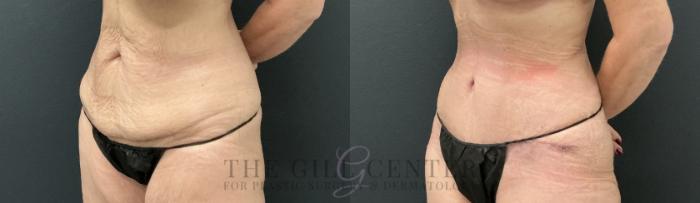 Tummy Tuck Case 813 Before & After Left Oblique | The Woodlands, TX | The Gill Center for Plastic Surgery and Dermatology
