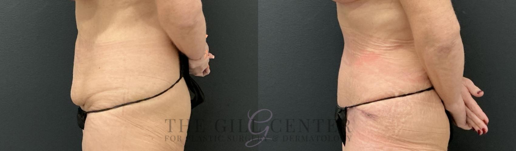 Tummy Tuck Case 813 Before & After Left Side | The Woodlands, TX | The Gill Center for Plastic Surgery and Dermatology