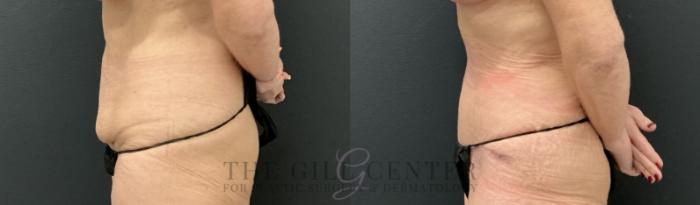 Tummy Tuck Case 813 Before & After Left Side | The Woodlands, TX | The Gill Center for Plastic Surgery and Dermatology