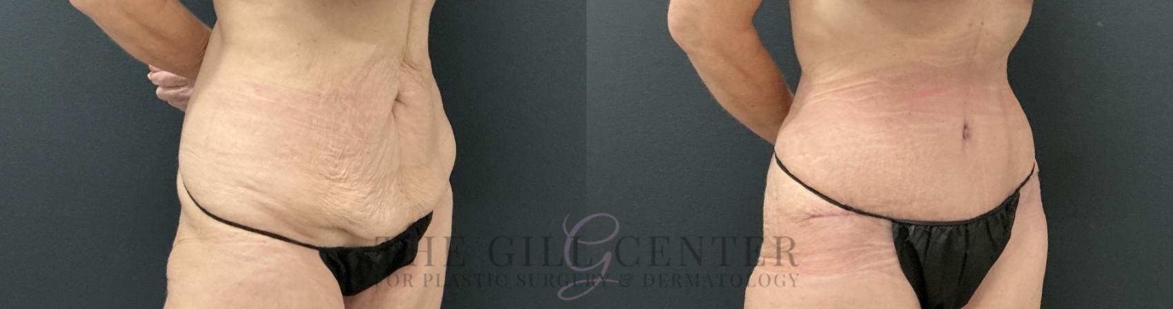 Tummy Tuck Case 813 Before & After Right Oblique | The Woodlands, TX | The Gill Center for Plastic Surgery and Dermatology