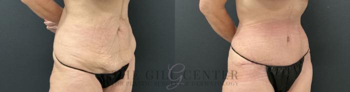 Tummy Tuck Case 813 Before & After Right Oblique | The Woodlands, TX | The Gill Center for Plastic Surgery and Dermatology