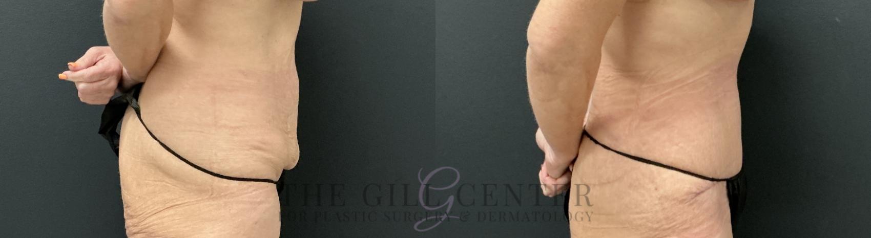 Tummy Tuck Case 813 Before & After Right Side | The Woodlands, TX | The Gill Center for Plastic Surgery and Dermatology