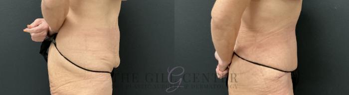 Tummy Tuck Case 813 Before & After Right Side | The Woodlands, TX | The Gill Center for Plastic Surgery and Dermatology
