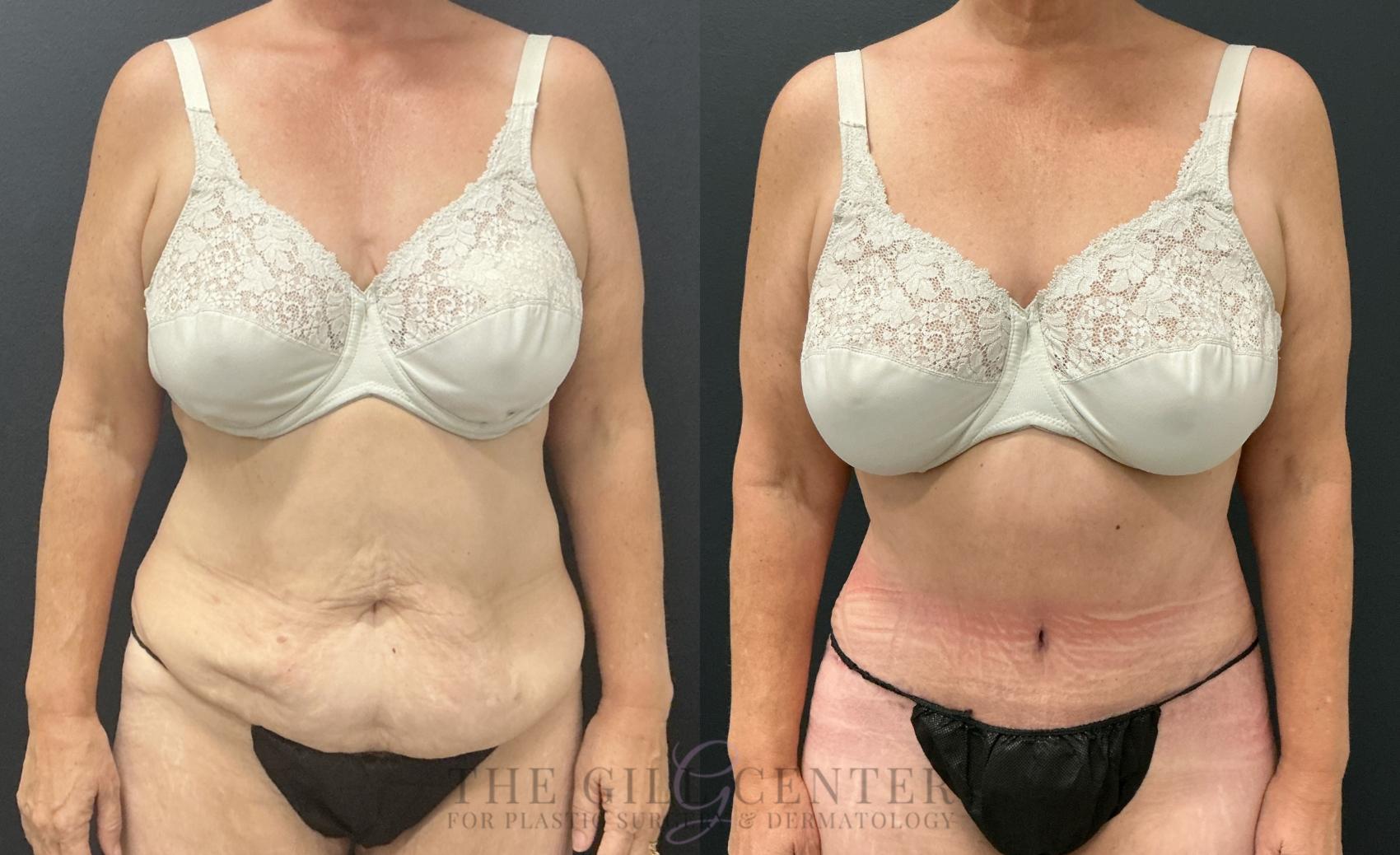 Tummy Tuck Case 820 Before & After Front | The Woodlands, TX | The Gill Center for Plastic Surgery and Dermatology