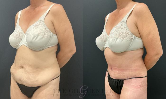 Tummy Tuck Case 820 Before & After Left Oblique | The Woodlands, TX | The Gill Center for Plastic Surgery and Dermatology