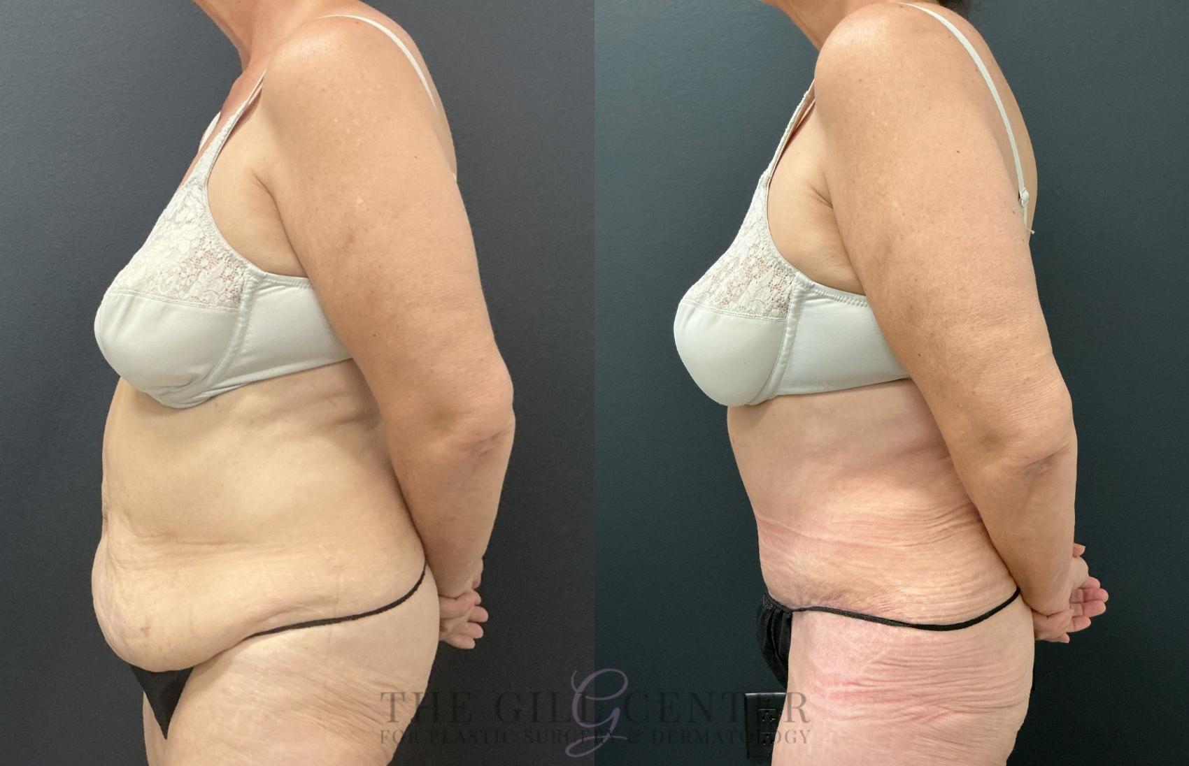 Tummy Tuck Case 820 Before & After Left Side | The Woodlands, TX | The Gill Center for Plastic Surgery and Dermatology