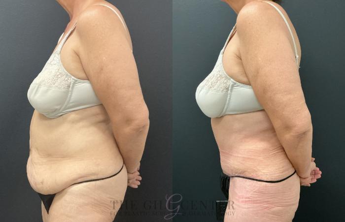 Tummy Tuck Case 820 Before & After Left Side | The Woodlands, TX | The Gill Center for Plastic Surgery and Dermatology